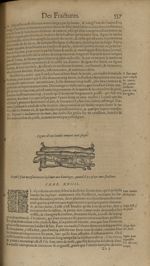 Figure d'une iambe rompuë auec playe - Les Oeuvres d'Ambroise Paré,...divisees en trente livres. Ave [...]