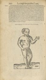 Figure prodigieuse d'un enfant ayant la face de grenouïlle - Les Oeuvres d'Ambroise Paré,...divisees [...]
