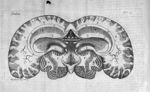 Tabula XIII. Cerebrum humanum hinc indè distractum, superiore utriusque hemisphaerij substantiâ, pau [...]