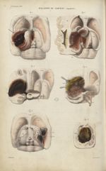 5e Livraison. Pl. 6. Maladies du cerveau. (Apoplexie) - Anatomie pathologique / tome 1