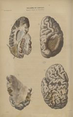 20e Livraison. Pl. 3. Maladies du cerveau. Apoplexie et atrophie des circonvolutions - Anatomie path [...]