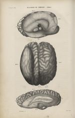 5e Livraison. Pl. 4. Maladies du cerveau. (Idiotie) - Anatomie pathologique / tome 1