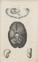 5e Livraison. Pl. 5. Maladies du cerveau. (Idiotie) - Anatomie pathologique / tome 1