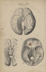 15e Livraison. Pl. 5. Maladies du cerveau. (Absence du cervelet) - Anatomie pathologique / tome 1