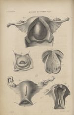11e Livraison. Pl. 6. Maladies de l'utérus. (Polypes). Fig. 1. - La saillie du museau de tanche dans [...]