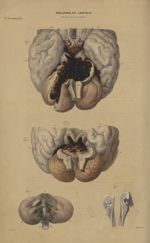 21e Livraison. Pl. 5. Maladies du cerveau. Apoplexie de la protubérance - Anatomie pathologique / to [...]