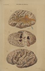 33e Livraison. Pl. 2. Maladies du cerveau. Fig. 1. - Face externe de l'hémisphère droit du cerveau / [...]