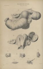 36e Livraison. Pl. 6. Maladies de l'ovaire. Grossesse extra-utérine. Fig. 1. - Fœtus appendu à l'ova [...]