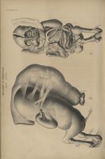 37e Livraison. Pl. 1. Maladies de péritoine. Grossesse péritonéale - Anatomie pathologique / tome 2