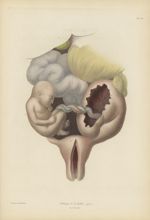 Planche XXXVI. Grossesse tubaire observée à la maternité chez une jeune femme, en 1816 - Anatomie pa [...]