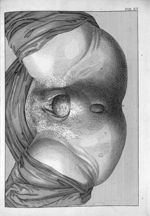 Tab. XV. [Pendant l'accouchement, la tête de l'enfant visible] - Tabulae anatomicae. Accedit earunde [...]