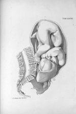 Tab. XXVIII. [Position du foetus pendant l'accouchement, vue de côté, avec une déformation du bassin [...]
