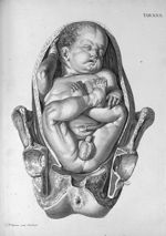 Tab. XXX. [Position de l'enfant se présentant par le siège au moment de l'accouchement] - Tabulae an [...]