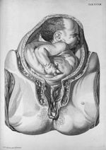 Tab. XXXIII. [Position de l'enfant au moment de l'accouchement] - Tabulae anatomicae. Accedit earund [...]
