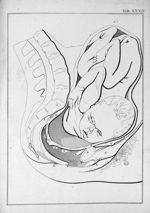 Tab. XXXIV. [Position de l'enfant au moment de l'accouchement, vue de côté] - Tabulae anatomicae. Ac [...]