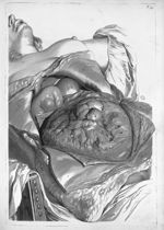 Mulieris ultra septem menses gravidae apertum abdomen  - Anatomia humani corporis, centum et quinque [...]