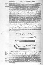 Cannules & aiguilles propres à faire les sutures - Les Oeuvres d'Ambroise Paré,... divisées en vingt [...]