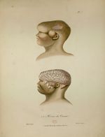 Hernie du cerveau - Atlas d'anatomie pathologique pour servir à l'histoire des maladies des enfans