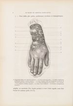 Dermatite herpétiforme - Le musée de l'hôpital Saint-Louis : iconographie des maladies cutanées et s [...]