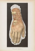 Dermatite herpétiforme - Le musée de l'hôpital Saint-Louis : iconographie des maladies cutanées et s [...]