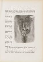 Chancre cupuliforme - Le musée de l'hôpital Saint-Louis : iconographie des maladies cutanées et syph [...]