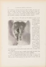 Chancre papuleux - Le musée de l'hôpital Saint-Louis : iconographie des maladies cutanées et syphili [...]