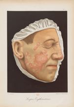 Lupus erythémateux - Le musée de l'hôpital Saint-Louis : iconographie des maladies cutanées et syphi [...]