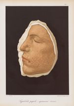 Syphilide papulo-squameuse circinée - Le musée de l'hôpital Saint-Louis : iconographie des maladies  [...]