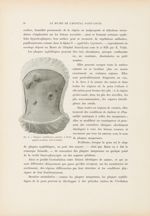 Fig. 3. Plaques syphilitiques géantes, à forme papulo-crouteuse - Le musée de l'hôpital Saint-Louis  [...]