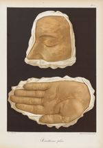 Xanthome plan - Le musée de l'hôpital Saint-Louis : iconographie des maladies cutanées et syphilitiq [...]