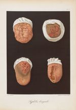 Syphilis linguale - Le musée de l'hôpital Saint-Louis : iconographie des maladies cutanées et syphil [...]
