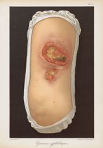 Gommes syphilitiques - Le musée de l'hôpital Saint-Louis : iconographie des maladies cutanées et syp [...]