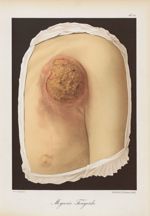 Mycosis fongoïde - Le musée de l'hôpital Saint-Louis : iconographie des maladies cutanées et syphili [...]