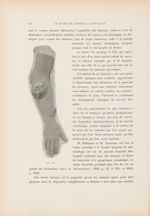 Fig. VI. Bras d'un malade atteint de mycosis : tumeurs mycosiques - Le musée de l'hôpital Saint-Loui [...]