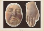 Lupus pernio - Le musée de l'hôpital Saint-Louis : iconographie des maladies cutanées et syphilitiqu [...]