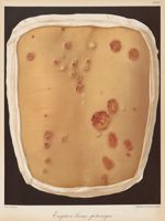 Eruption bromo-potassique - Le musée de l'hôpital Saint-Louis : iconographie des maladies cutanées e [...]