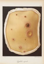 Syphilide rupoïde - Le musée de l'hôpital Saint-Louis : iconographie des maladies cutanées et syphil [...]