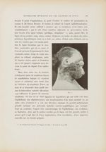 Fig. 4. [Epithéliome] - Le musée de l'hôpital Saint-Louis : iconographie des maladies cutanées et sy [...]