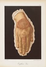 Erythème iris - Le musée de l'hôpital Saint-Louis : iconographie des maladies cutanées et syphilitiq [...]