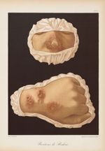 Boutons de Biskra - Le musée de l'hôpital Saint-Louis : iconographie des maladies cutanées et syphil [...]