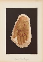 Eczéma kératodermique - Le musée de l'hôpital Saint-Louis : iconographie des maladies cutanées et sy [...]