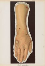Gale pustuleuse - Le musée de l'hôpital Saint-Louis : iconographie des maladies cutanées et syphilit [...]