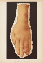 Lymphangite tuberculeuse - Le musée de l'hôpital Saint-Louis : iconographie des maladies cutanées et [...]