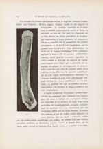 Fig. 1. [Gommes tuberculeuses lymphangitiques consécutives à une dactylite tuberculeuse] - Le musée  [...]