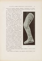 Fig. 2. [Gommes tuberculeuses lymphangitiques consécutives à une dactylite tuberculeuse] - Le musée  [...]