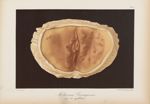 Molluscum contagiosum chez une syphilitique - Le musée de l'hôpital Saint-Louis : iconographie des m [...]