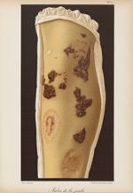 Naevus de la jambe - Le musée de l'hôpital Saint-Louis : iconographie des maladies cutanées et syphi [...]