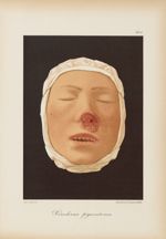 Xeroderma pigmentosum - Le musée de l'hôpital Saint-Louis : iconographie des maladies cutanées et sy [...]