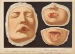 Chancre syphilitique de la lèvre (forme crouteuse). Chancre syphilitique de la lèvre. Chancre syphil [...]