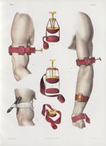 Planche 20 - Compression des artères du membre thoracique - Traité complet de l'anatomie de l'homme, [...]